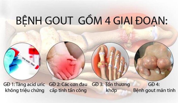 Các giai đoạn của bệnh gout