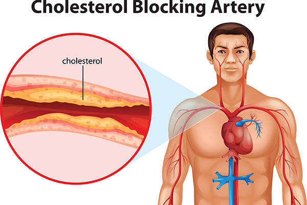 Ảnh 6: Cây nần vàng giúp giảm chỉ số cholesterol máu ở 100% người bệnh