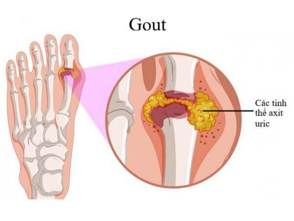 Ảnh 3: Acid uric tăng cao dẫn đến bệnh gout