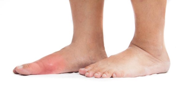 Đau ngón chân cái - triệu chứng điển hình của axit uric cao
