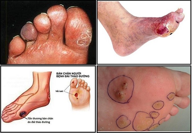 Những tổn thương trên bàn chân do biến chứng tiểu đường