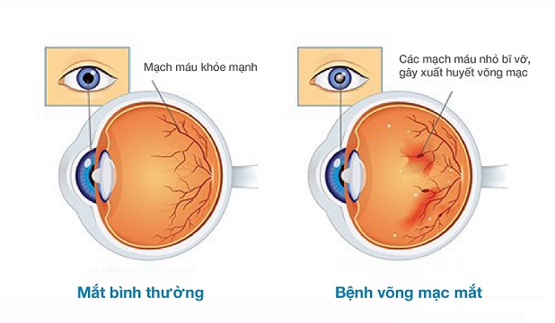 Biến chứng tiểu đường ở mắt