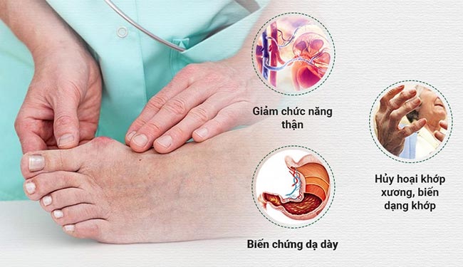Một số hậu quả do bệnh gout gây ra