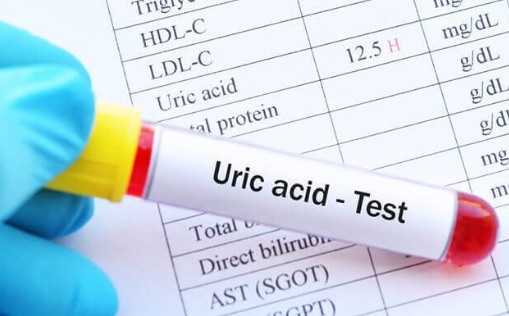 Kiểm tra acid uric máu - Cách nhận biết bệnh gút chính xác nhất