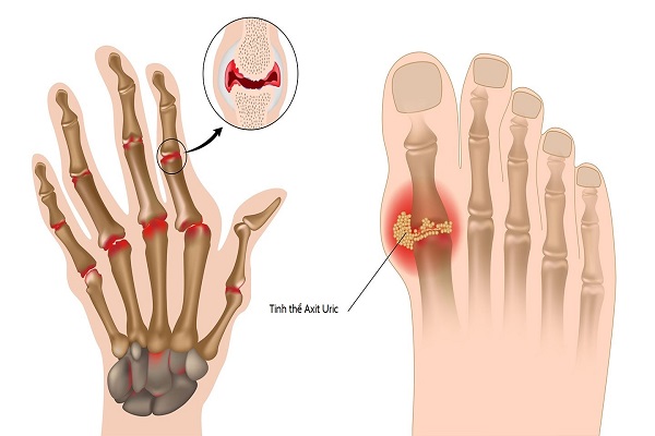 Ảnh: Cây lá gan hỗ trợ điều trị gout