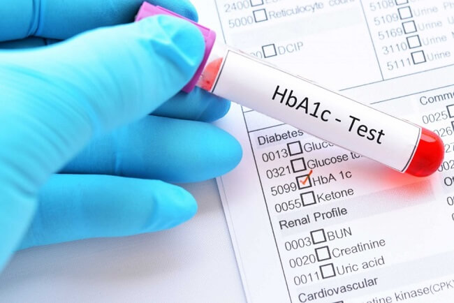 Xét nghiệm HbA1c để chẩn đoán tiểu đường type 1