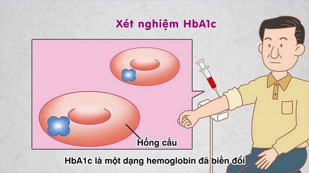 Xét nghiệm HbA1c định kỳ để biết được tình trạng sức khỏe