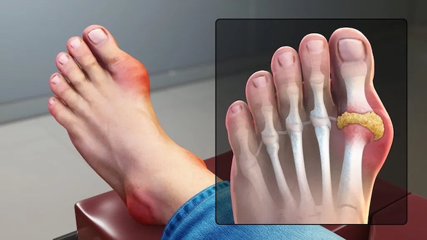 Bệnh gút ngón chân cái
