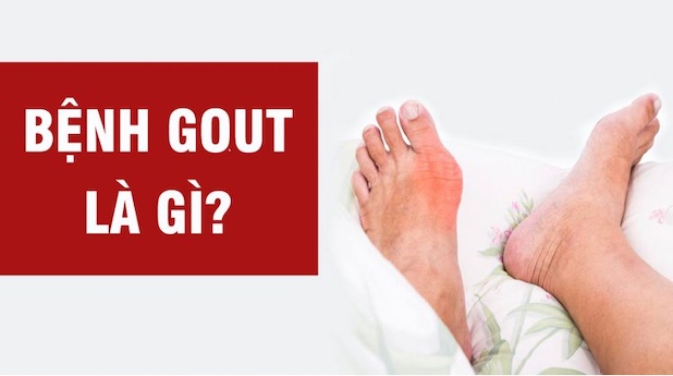 Bệnh gout là gì?