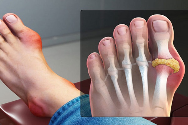 Ảnh: Ngâm chân là phương pháp hỗ trợ điều trị gout hiệu quả