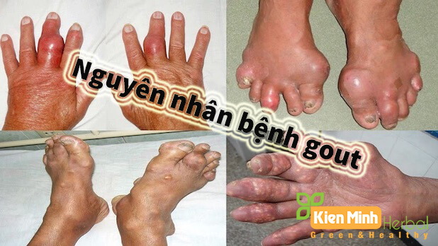 Nguyên nhân bệnh gout là gì