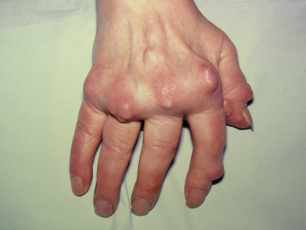Dấu hiệu bệnh gout giai đoạn mãn tính