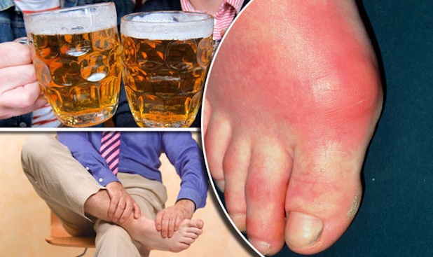 Rượu bia làm tăng nguy cơ mắc bệnh gout