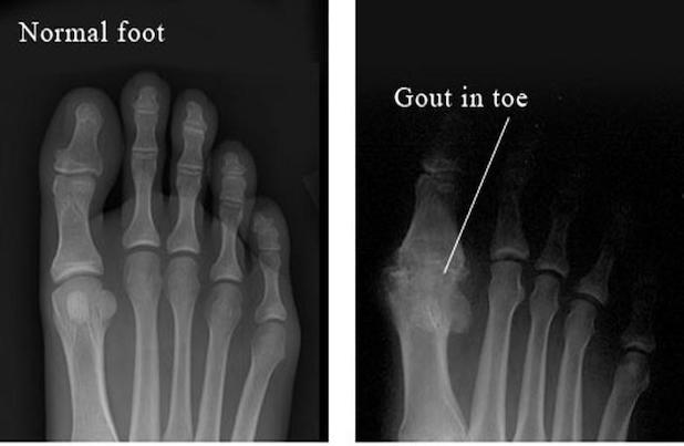 Chụp x-quang giúp phát hiện sớm bệnh gout