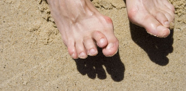 Đau ngón chân cái - triệu chứng điển hình của bệnh gout