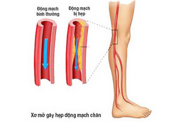 Ảnh : Tê bàn chân do bệnh lý liên quan đến động mạch ngoại biên