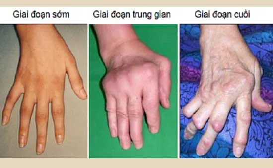 Gout cấp là 1 trong những nguyên nhân gây viêm khớp