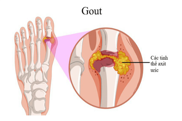 Ảnh: Việt quất hỗ trợ điều trị bệnh gout