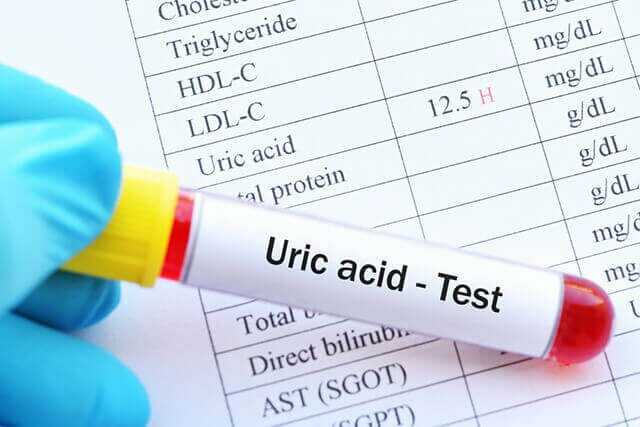 Ảnh: xét nghiệm nồng độ acid uric trong máu